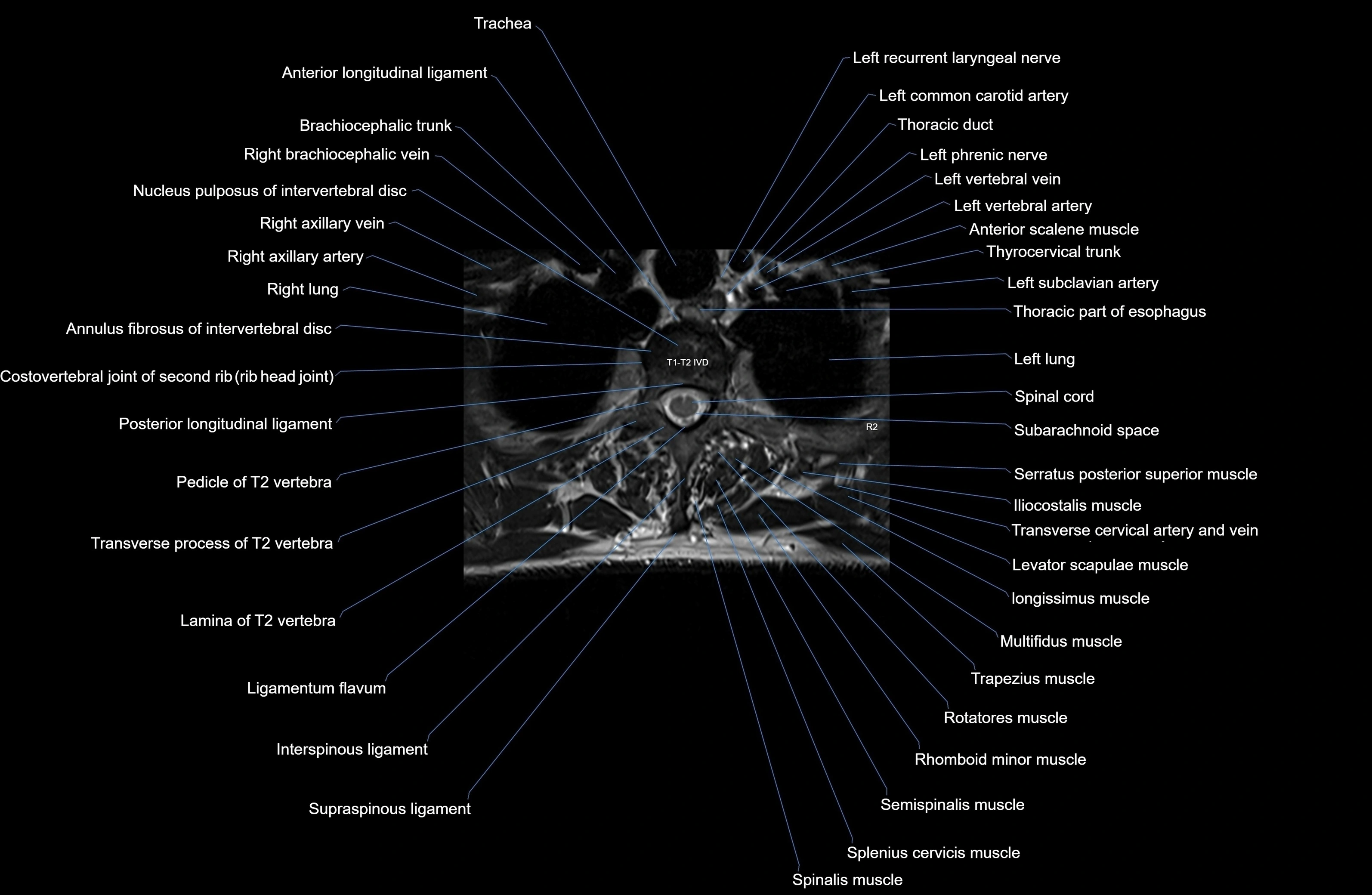 MRI thoracic spine axial  cross sectional anatomy 3T radiology  image-img-00001-00013.webp